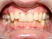 REFACEREA OBTURATIILOR FRONTALE. Aspect final