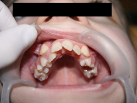 Aspect intraoral