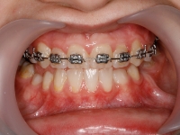 S-a extras 1.4 primul premolar si s-a aplicat aparatul fix