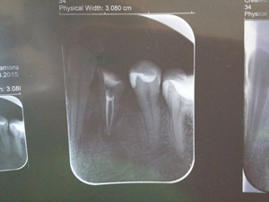 tratament endodontic pe 34 s